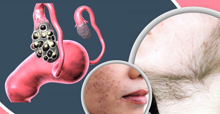 PCOS মানে শুধু ব্রণ, ওজন বেড়ে যাওয়া বা পিরিয়ড গোলমাল নয়
